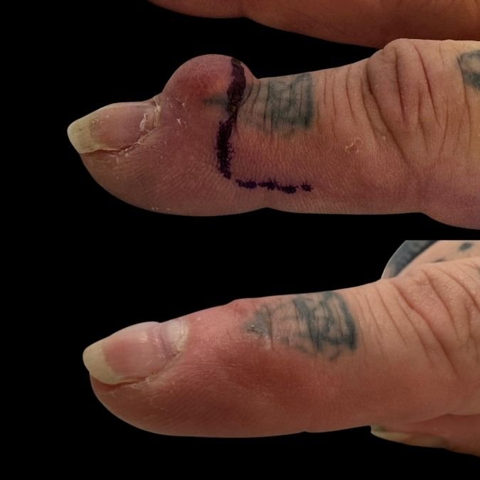 Mucous cyst excision surgery​ results by Miss Jurga Pikturnaite, hand surgeon