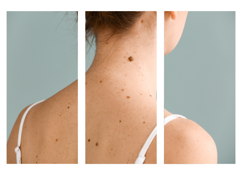 Skin Services | Bristol, Bath, Newport and Gloucester
