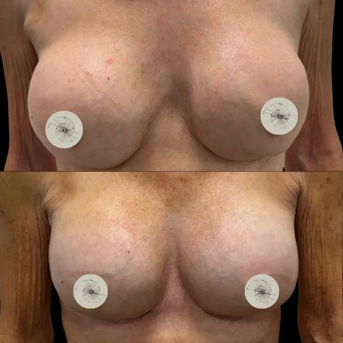 Before and After Breast Implant Exchange