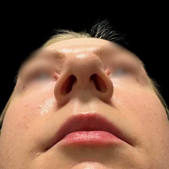 Tip Rhinoplasty before and after by Miss Jurga Pikturnaite, female plastic surgeon.