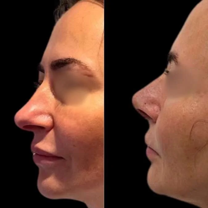 Rhinoplasty - GA Rhinoplasty Page.jpg