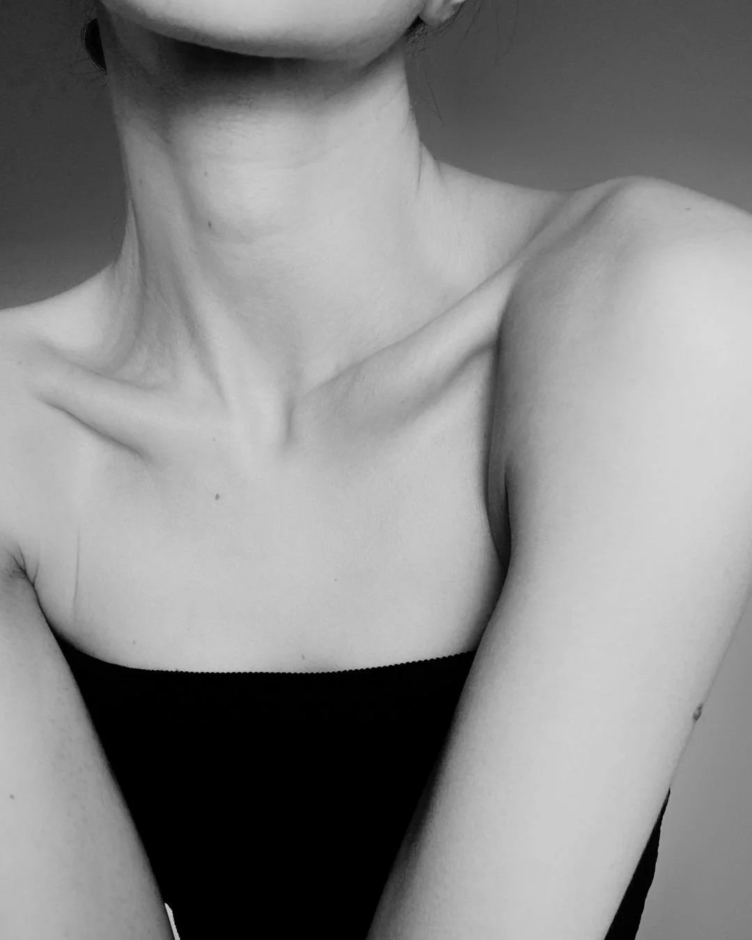 Woman neck showcasing jowl reduction surgery