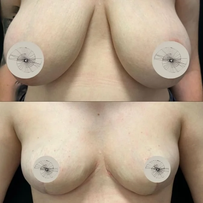 Before and After Breast Reduction