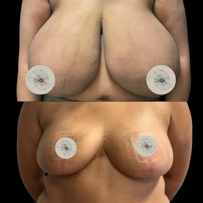 Before and After Gigantomastia Reduction