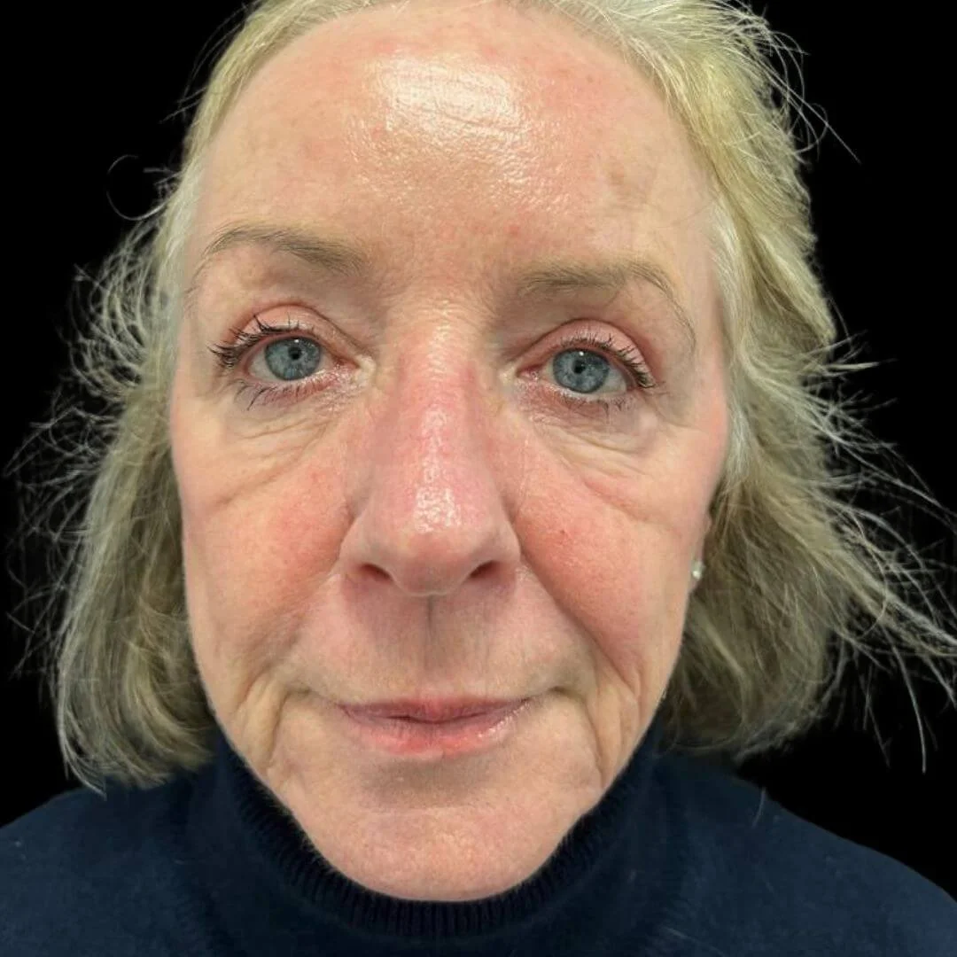 Upper Blepharoplasty before and after, after image