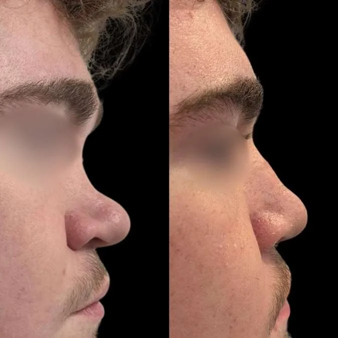 Reconstructed Bridge Rhinoplasty - GA Rhinoplasty Page.jpg