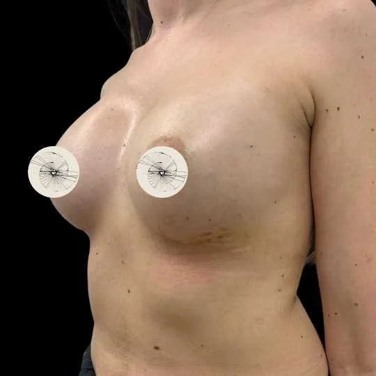 Side view of a woman's bare chest with stickers covering her nipples, against a black background.