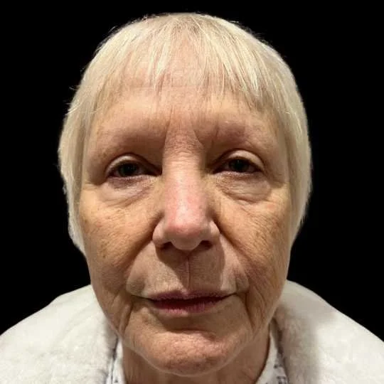 Before Facelift bristol