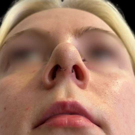 Tip Rhinoplasty before and after by Miss Jurga Pikturnaite, female plastic surgeon.