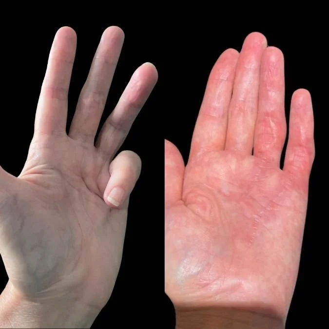 Before and After dupuytren's contracture surgery results by Miss Jurga Pikturnaite, hand surgeon​