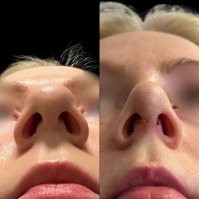 Tip Rhinoplasty - GA Rhinoplasty Page.jpg