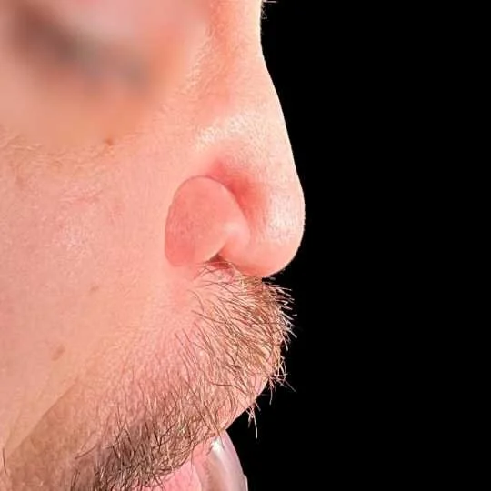 Septorhinoplasty results by Mr Shaheel Chummun