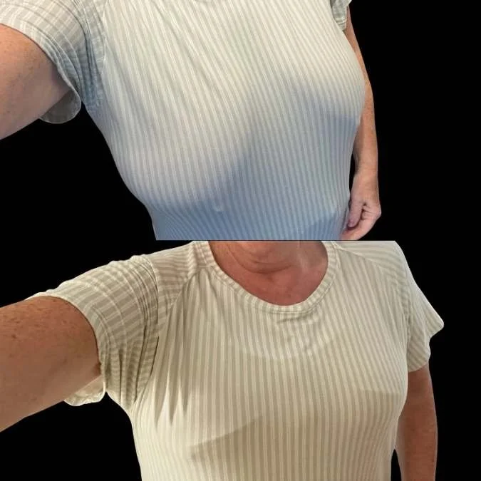 Breast Reduction Results with Mr Shaheel Chummun, breast surgeon