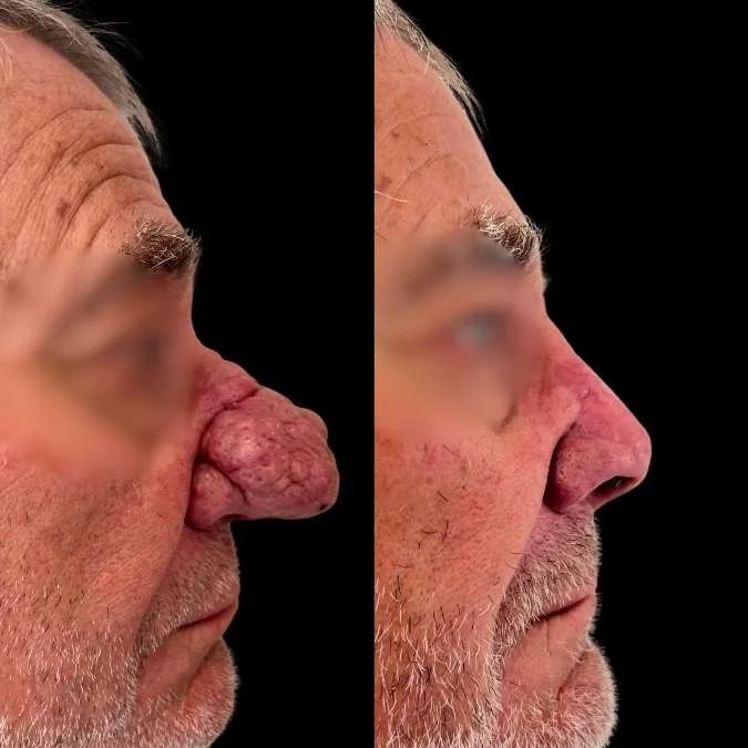 Rhinophyma Excision - GA Rhinoplasty Page.jpg