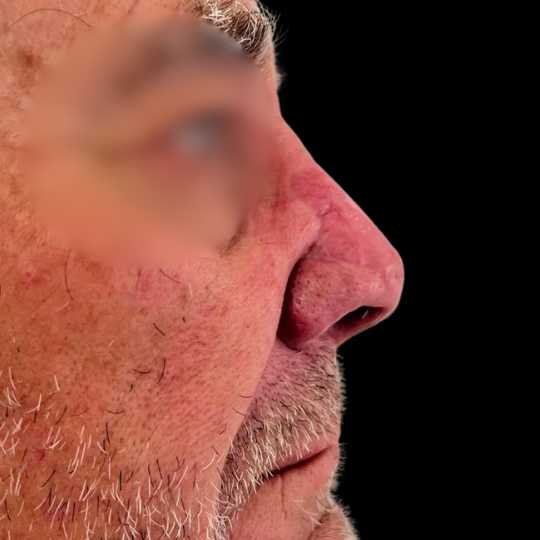 Close-up side profile of a man's face, showing skin redness and facial hair, with blurred eyes and a black background.