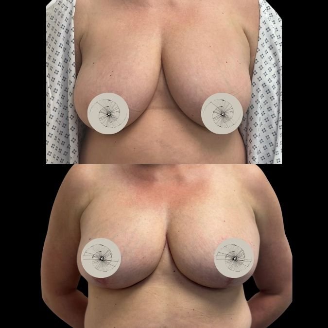 Breast Reduction before and after done by Miss Jurga Pikturnaite
