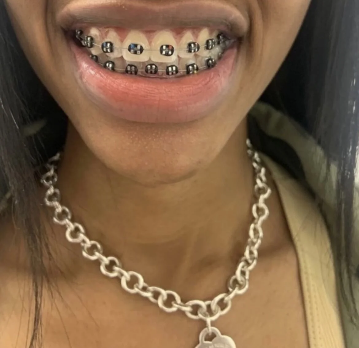 Fake Braces — Shop Fake Braces — 14KSmiles