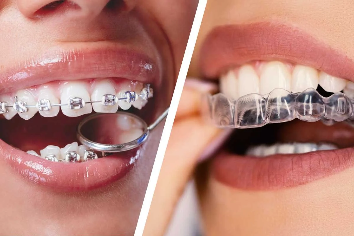 Invisalign or Braces?