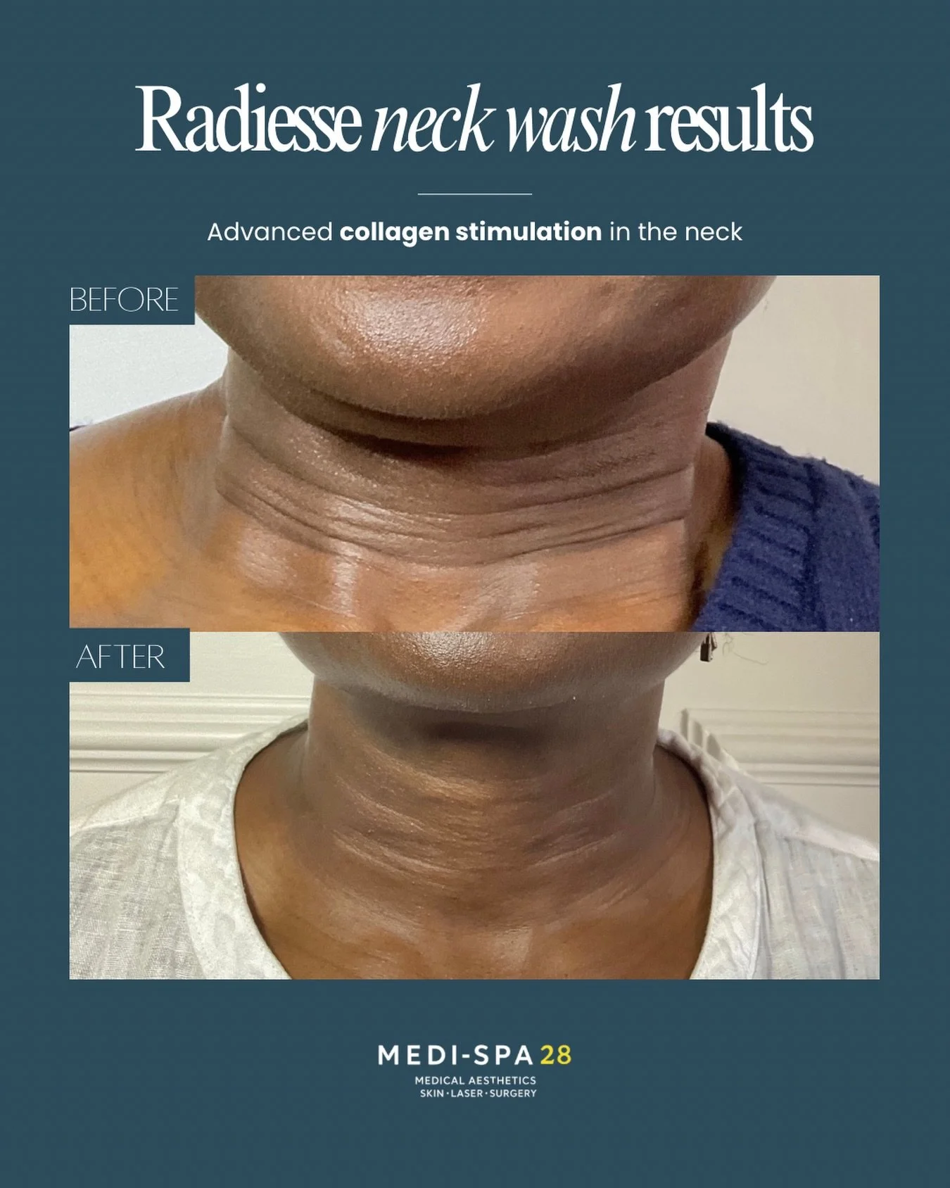 These Radiesse Neck Wash results show the power of biostimulation when treating delicate areas of the skin 💛

Unlike traditional filler, hyper-dilute Radiesse is designed to stimulate your body&rsquo;s natural collagen and elastin production, helpin