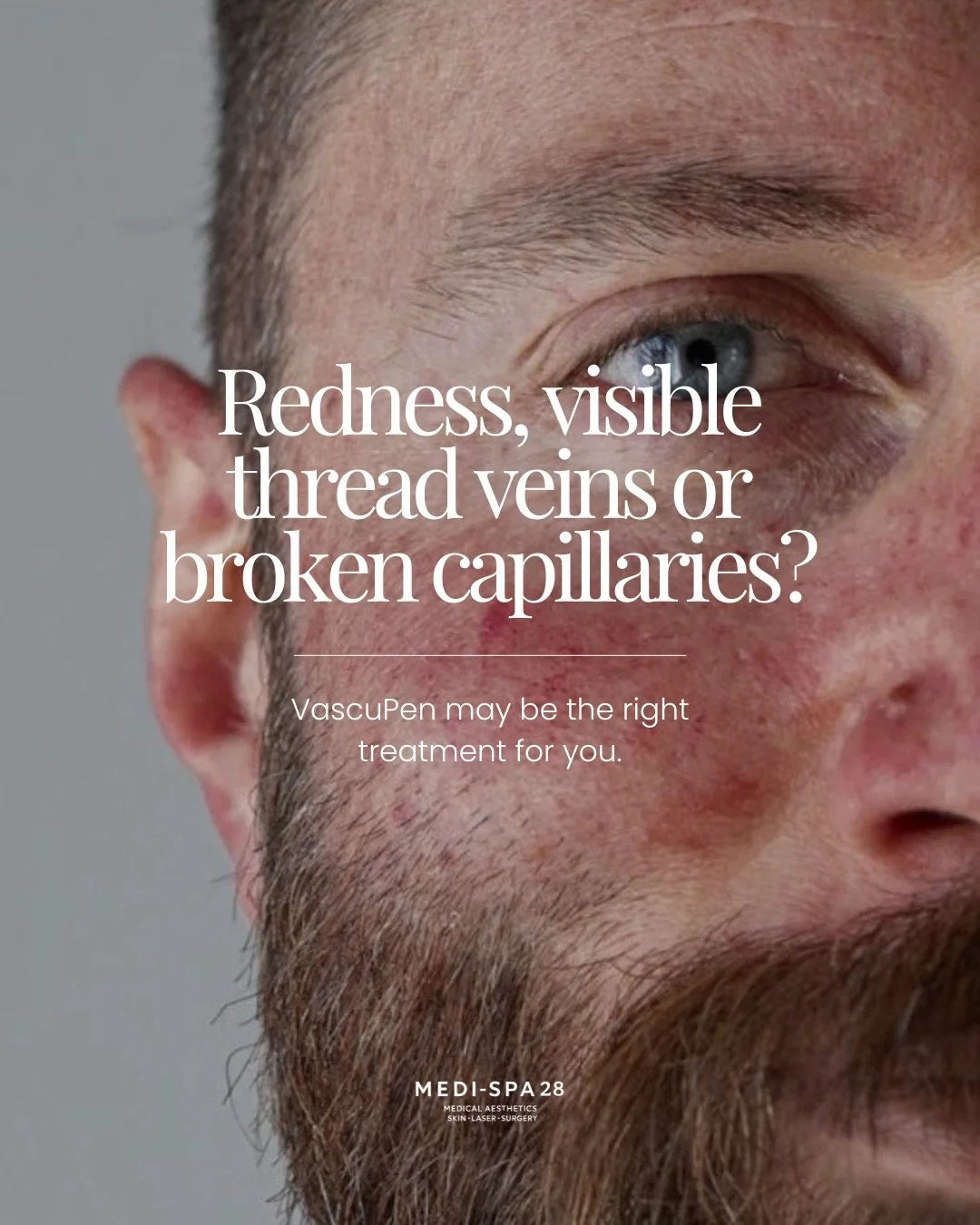 Healthy skin isn&rsquo;t just about texture, tone or glow - it&rsquo;s also about addressing the visible concerns that can make your skin look flushed, uneven or irritated.

VascuPen is ideal for those small but stubborn areas of redness or visible t