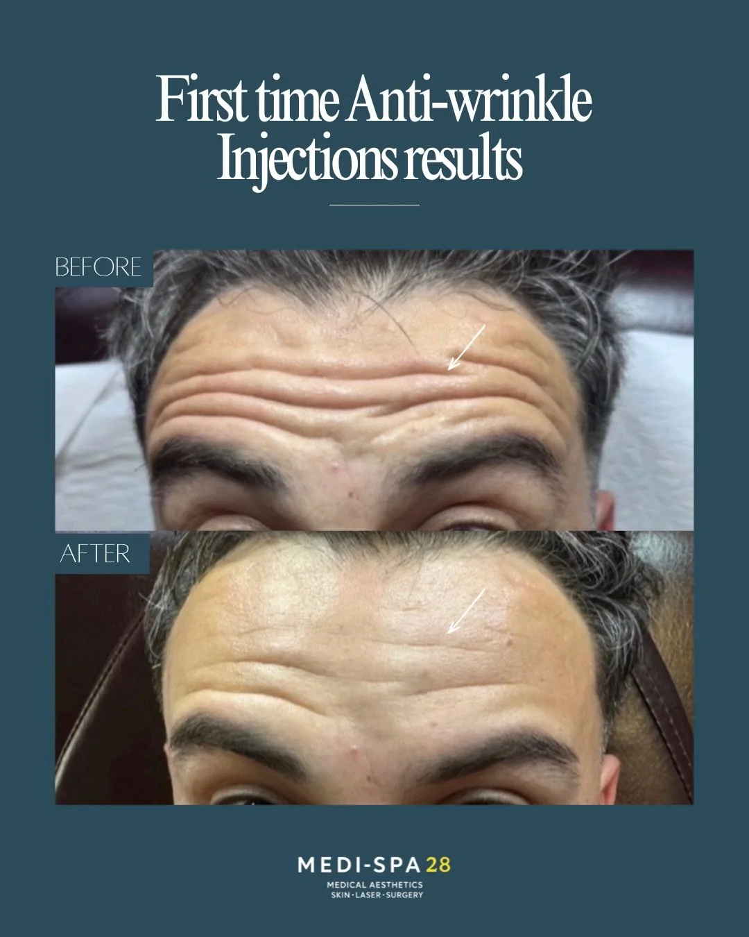 First time Anti-wrinkle Injections results 💛

Botulinum toxin (anti-wrinkle injections) is a quick, virtually painless treatment that works to relax targeted muscles, softening fine lines and wrinkles for a refreshed, rejuvenated appearance.

A smal