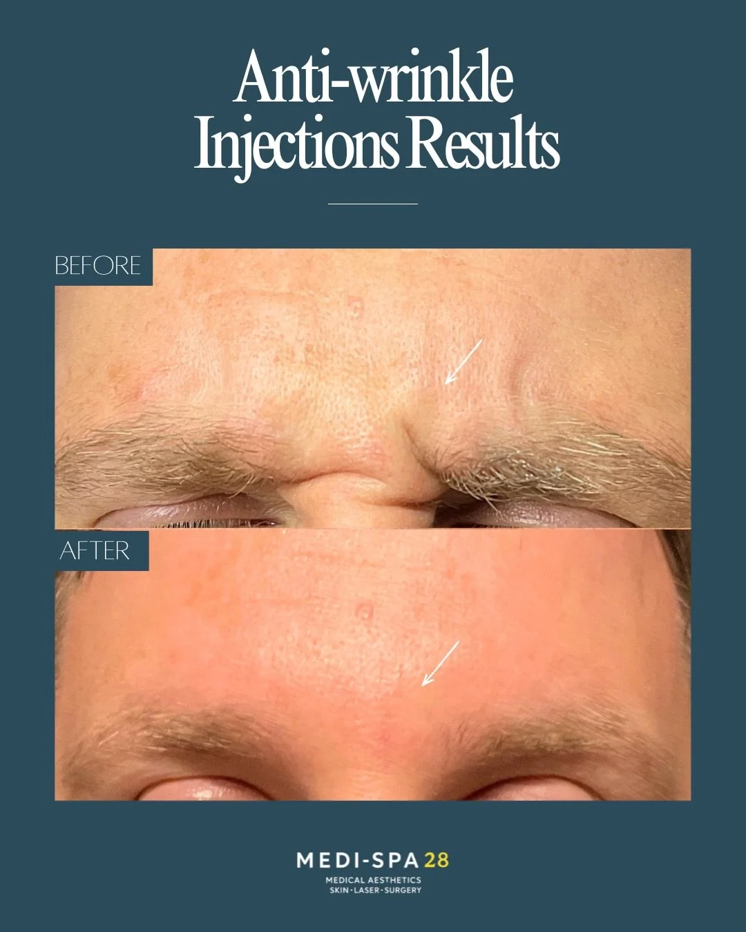 Subtle changes can make all the difference.

More and more men are choosing anti-wrinkle treatments, not to look different, but to look like a fresher, more well-rested version of themselves.

A small amount of botulinum toxin can soften forehead lin