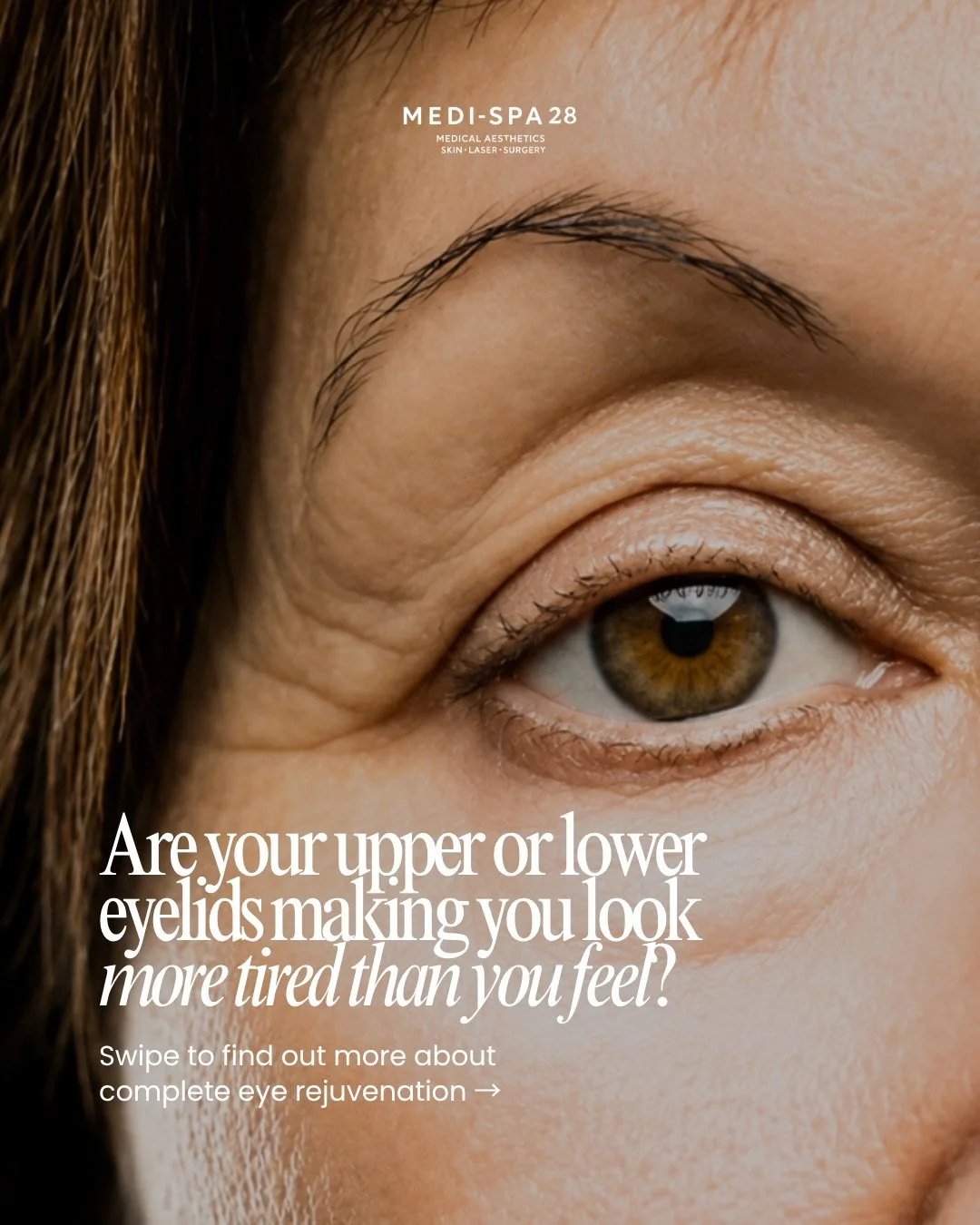 Considering upper or lower eyelid surgery&hellip; or both? 👁️

Blepharoplasty (eyelid surgery) can help address concerns such as heavy or hooded upper eyelids, excess skin, under-eye bags and puffiness, creating a more refreshed appearance while mai