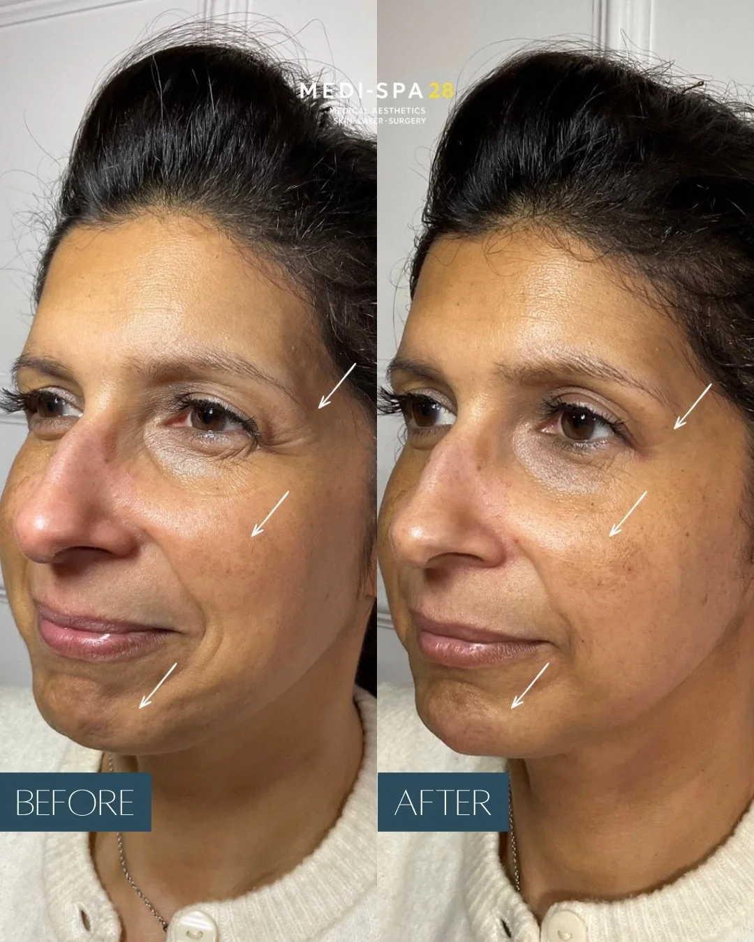 Patient results 💛

It&rsquo;s always a pleasure to treat a fellow professional within the industry and to be trusted with something as personal as their face.

For this first-time dermal filler patient, we focused on gentle profile balancing using a