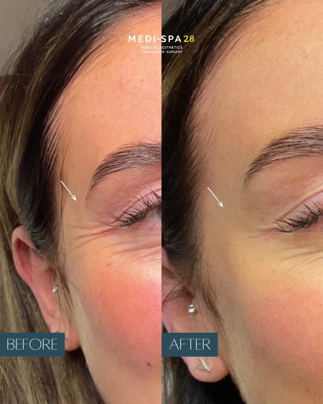We LOVE these Anti-Wrinkle Injections Results 💛

Botulinum toxin (anti-wrinkle injections) is a fast, virtually painless treatment that softens and relaxes muscles to smooth out fine lines and wrinkles - giving you a rejuvenated, youthful appearance