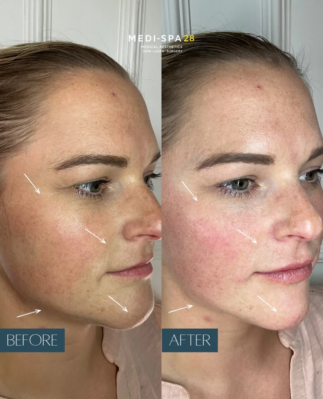 6ml of dermal filler&hellip; is it noticeable? 💉

6ml might sound like a lot, but when strategically placed across different areas of the face, it can make a beautiful yet subtle difference.

For Sam, Dan&rsquo;s focus was on restoring lost volume, 