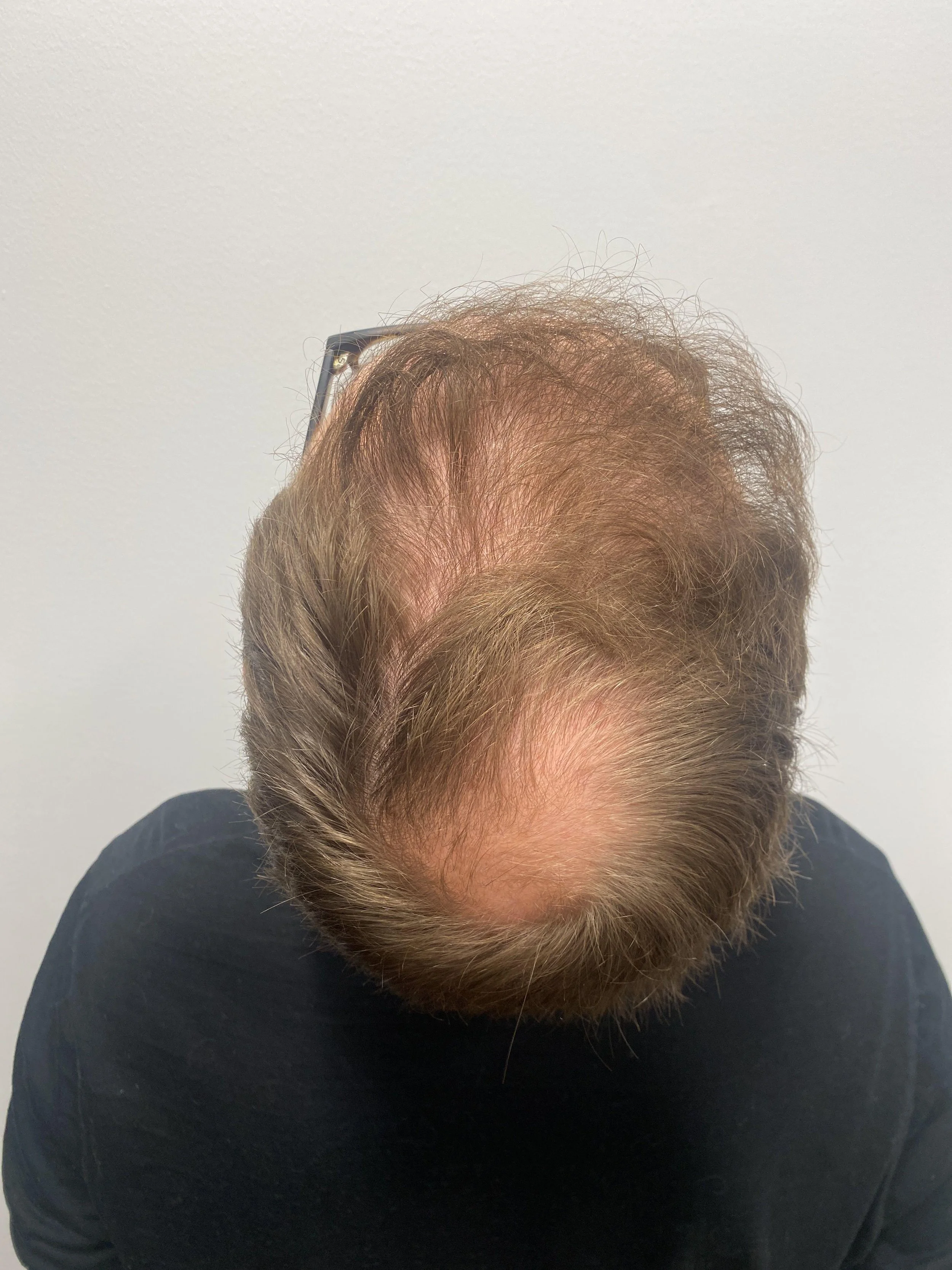 Crown view 11 months after first hair transplant to frontal scalp