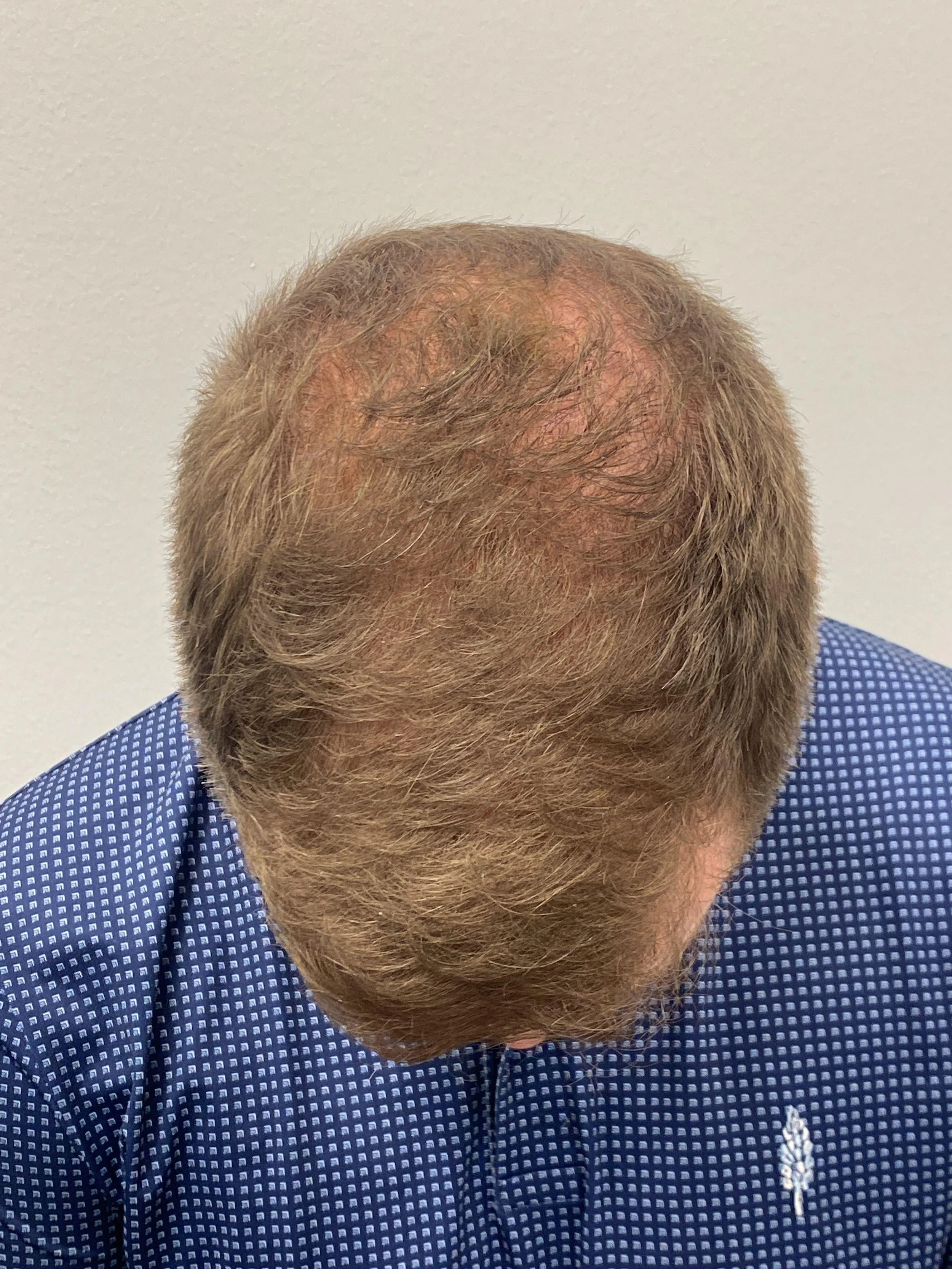 Top view 10 months post op