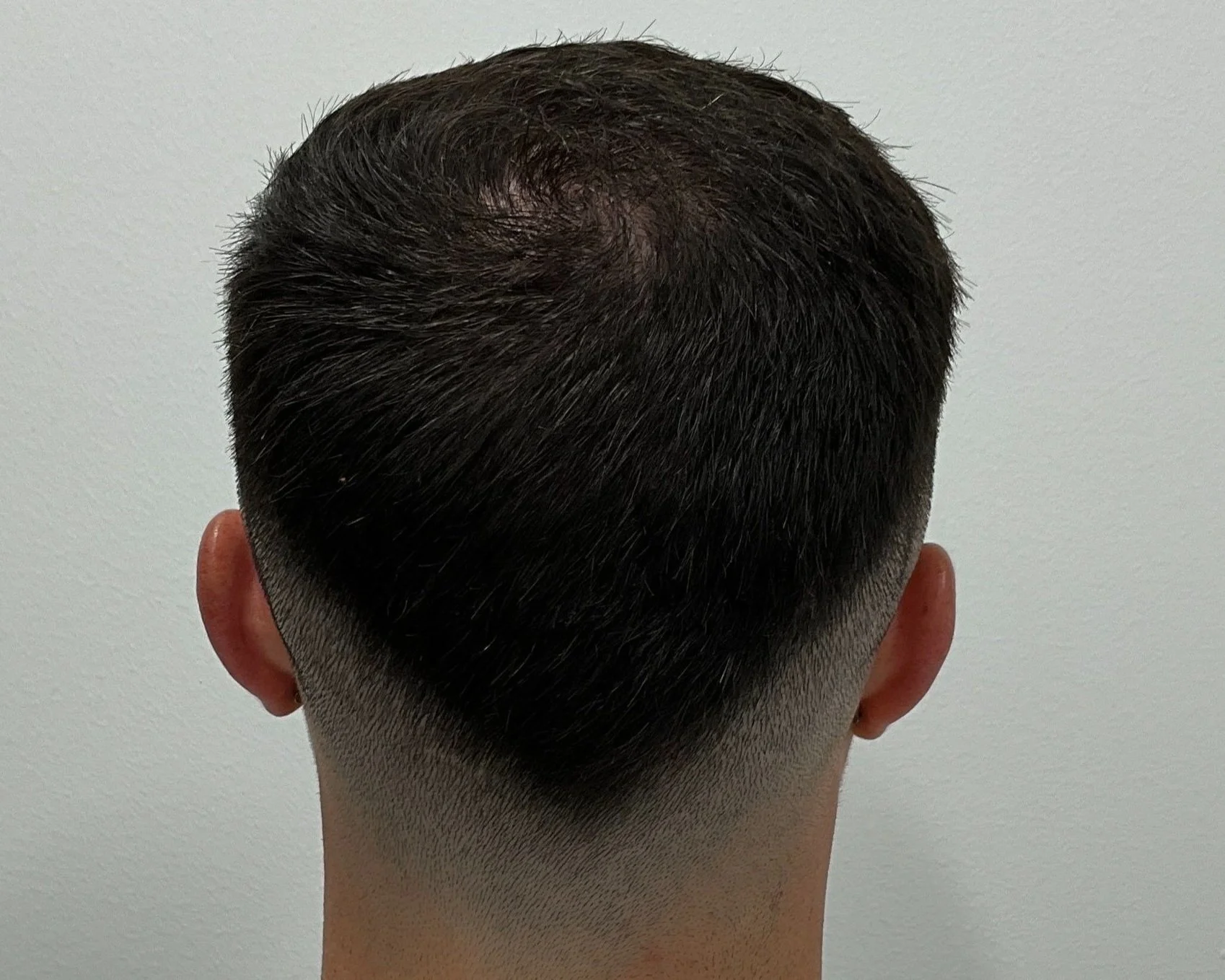 6 months post op in the crown region with another 6 to 8 months of improvement to come.