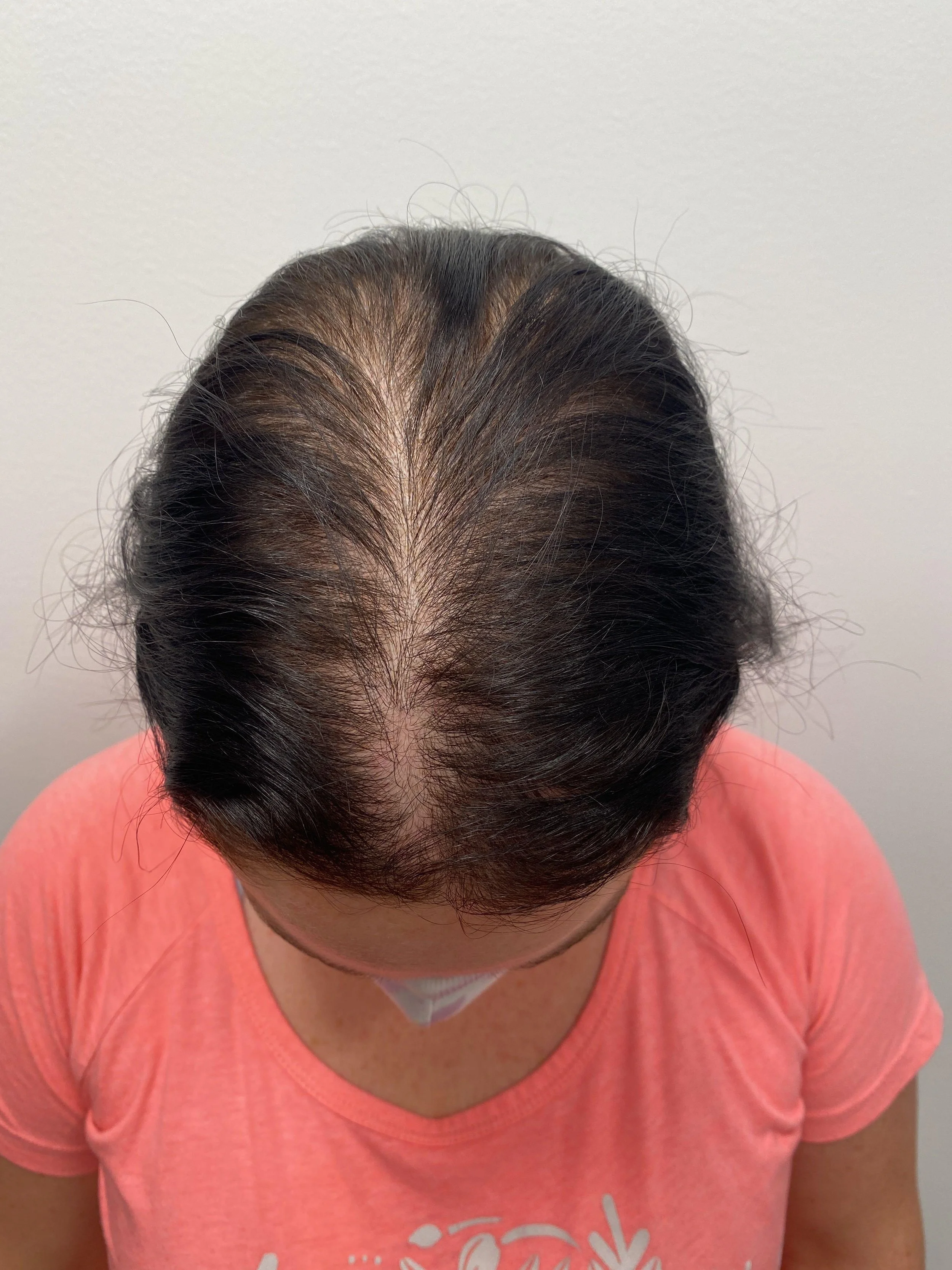 Top view 7 months post op