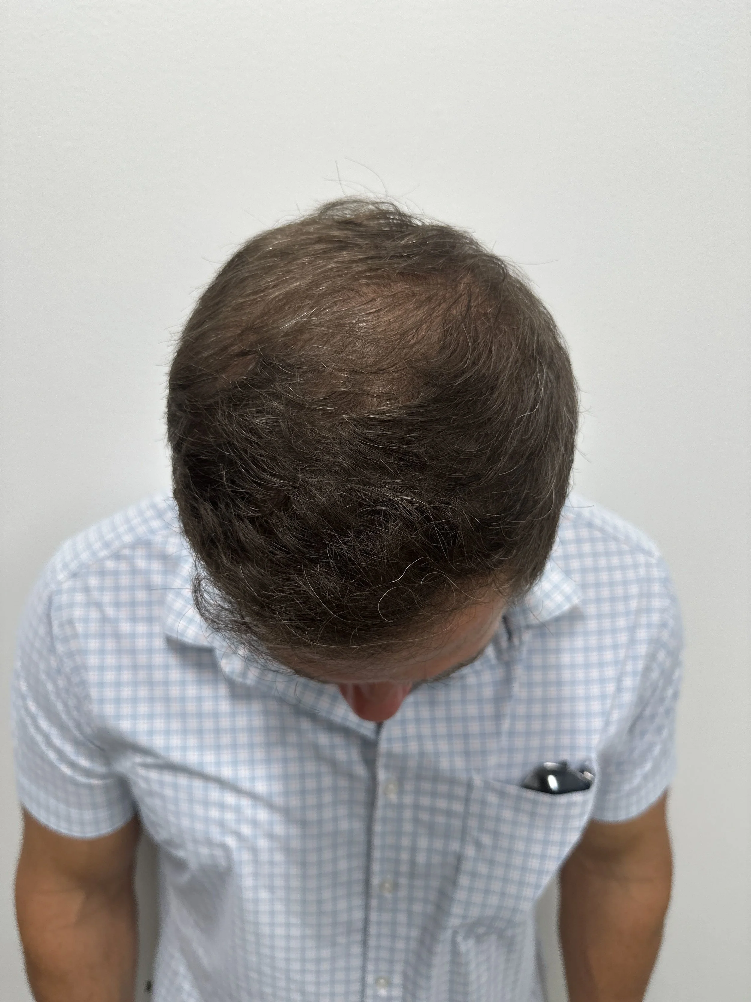 Top view 11 months post op