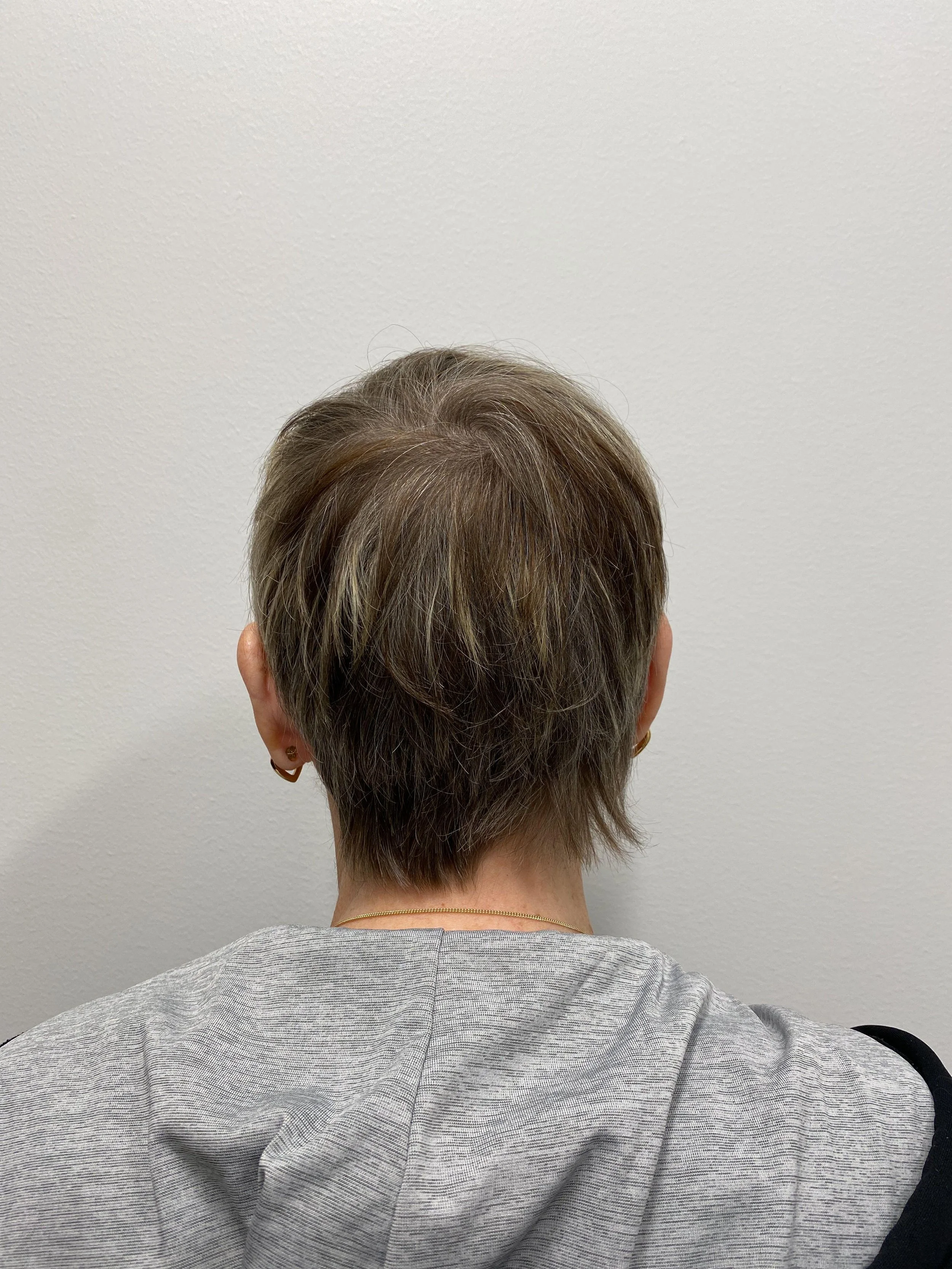 Donor area 1 year post op