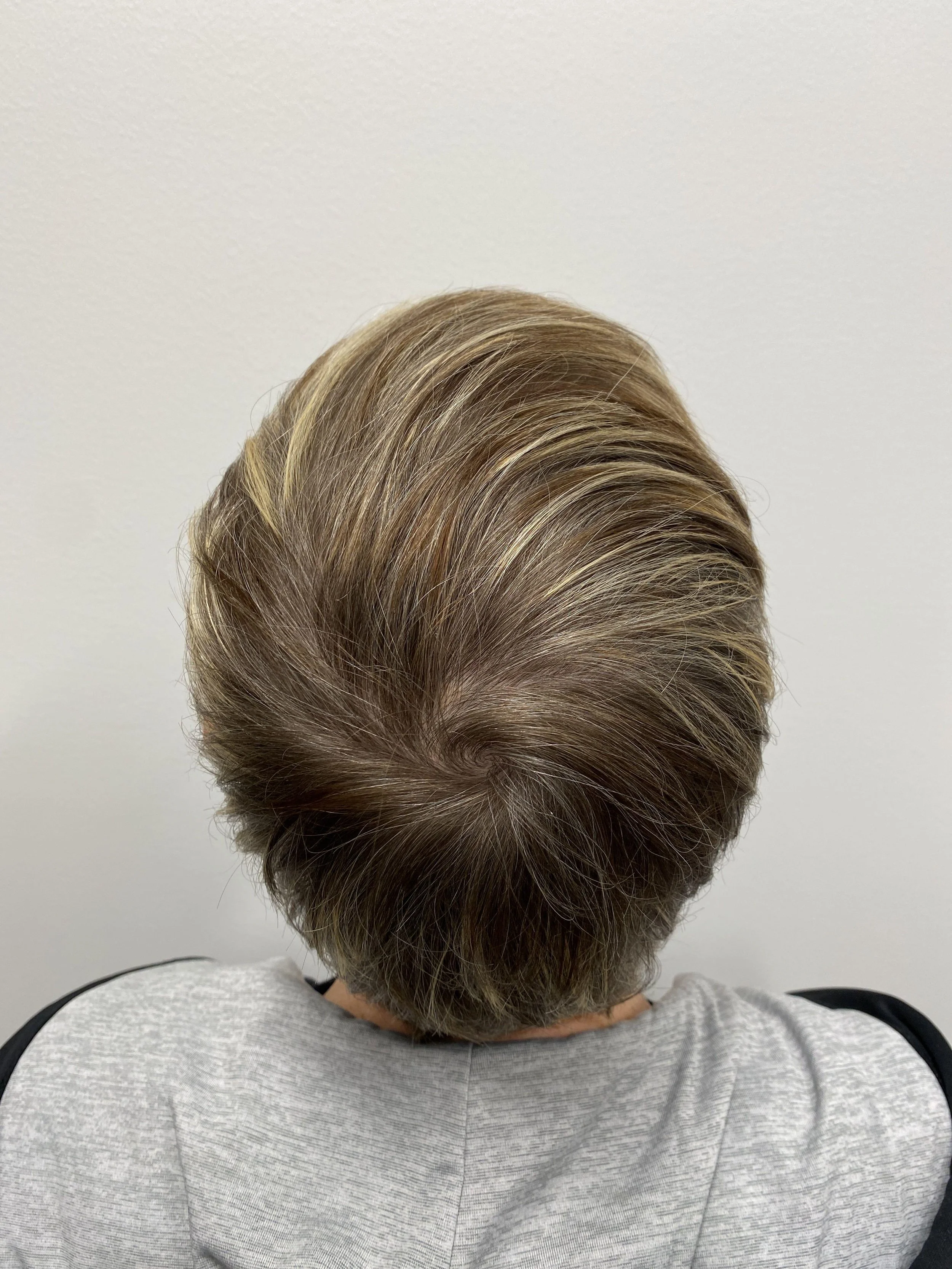 Crown view 1 year post op