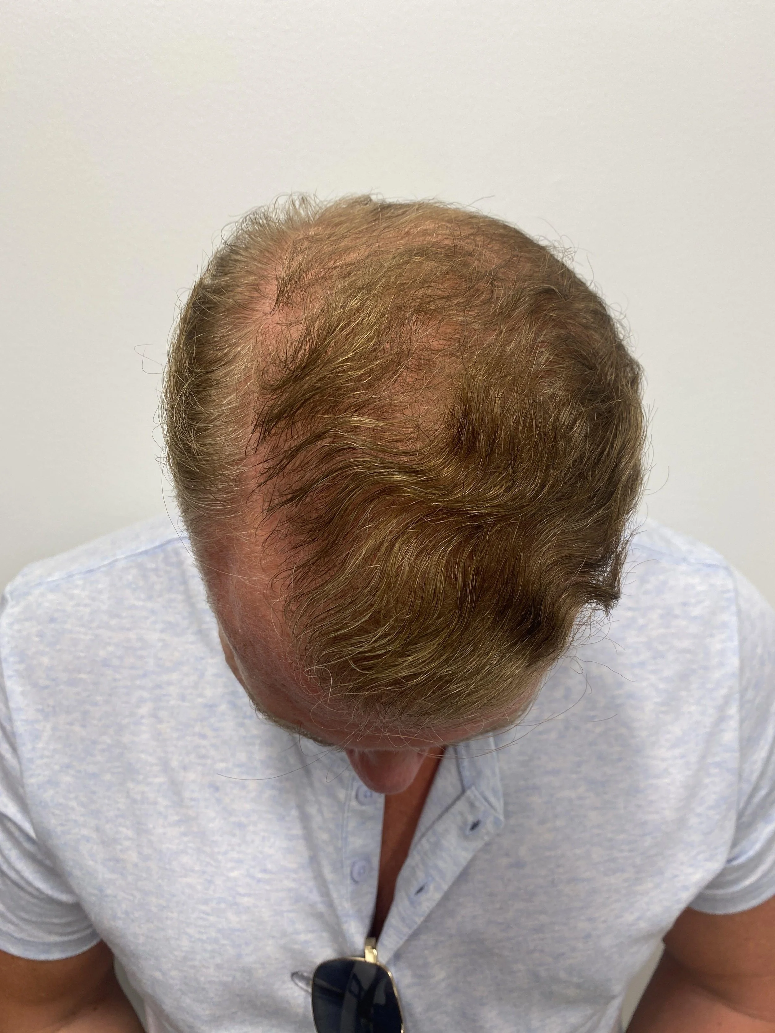 1 Year after ARTAS iX hair transplant to frontal scalp using 2200 grafts