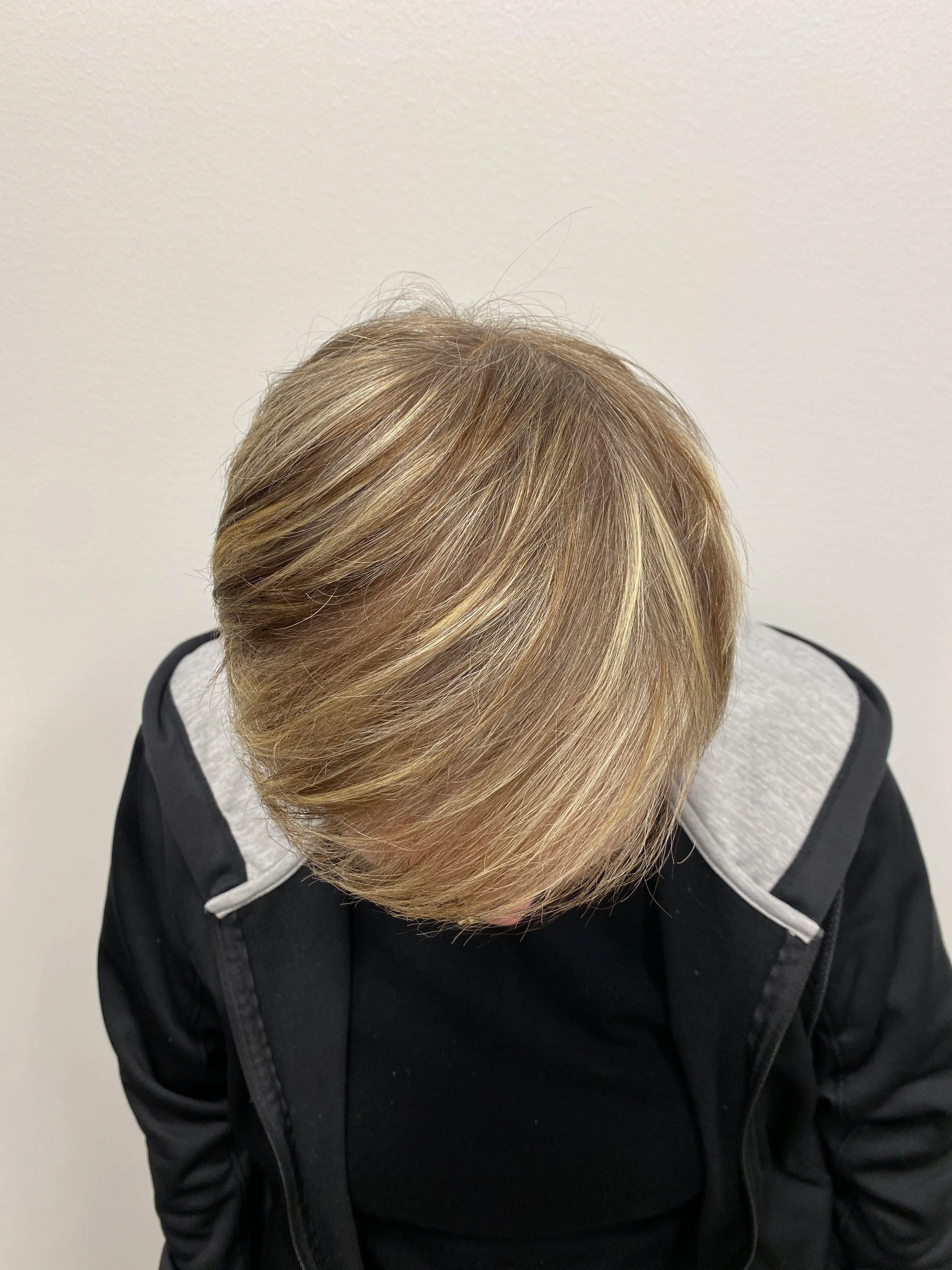 Top view 1 year post op