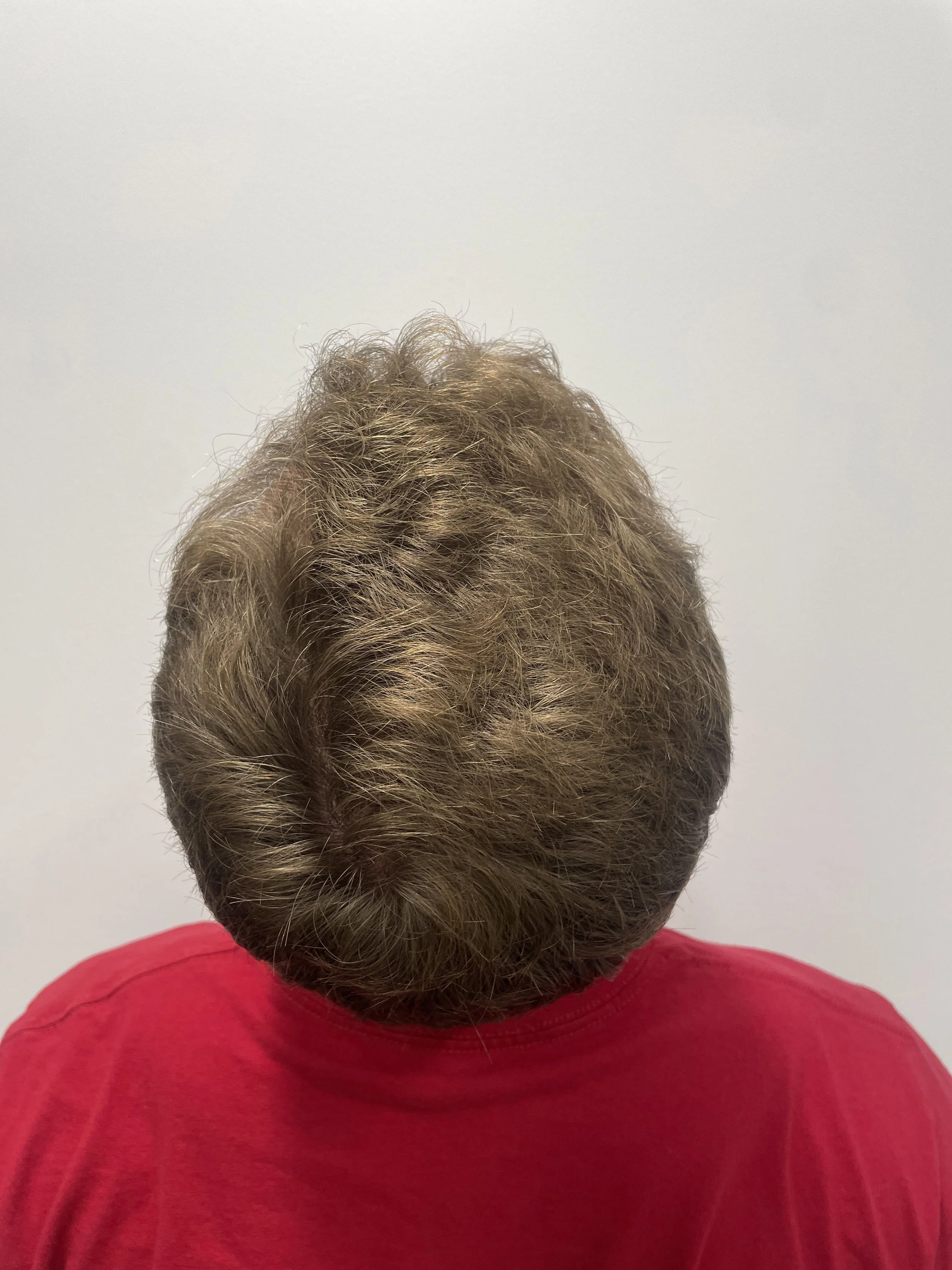 Crown view 7 months post op