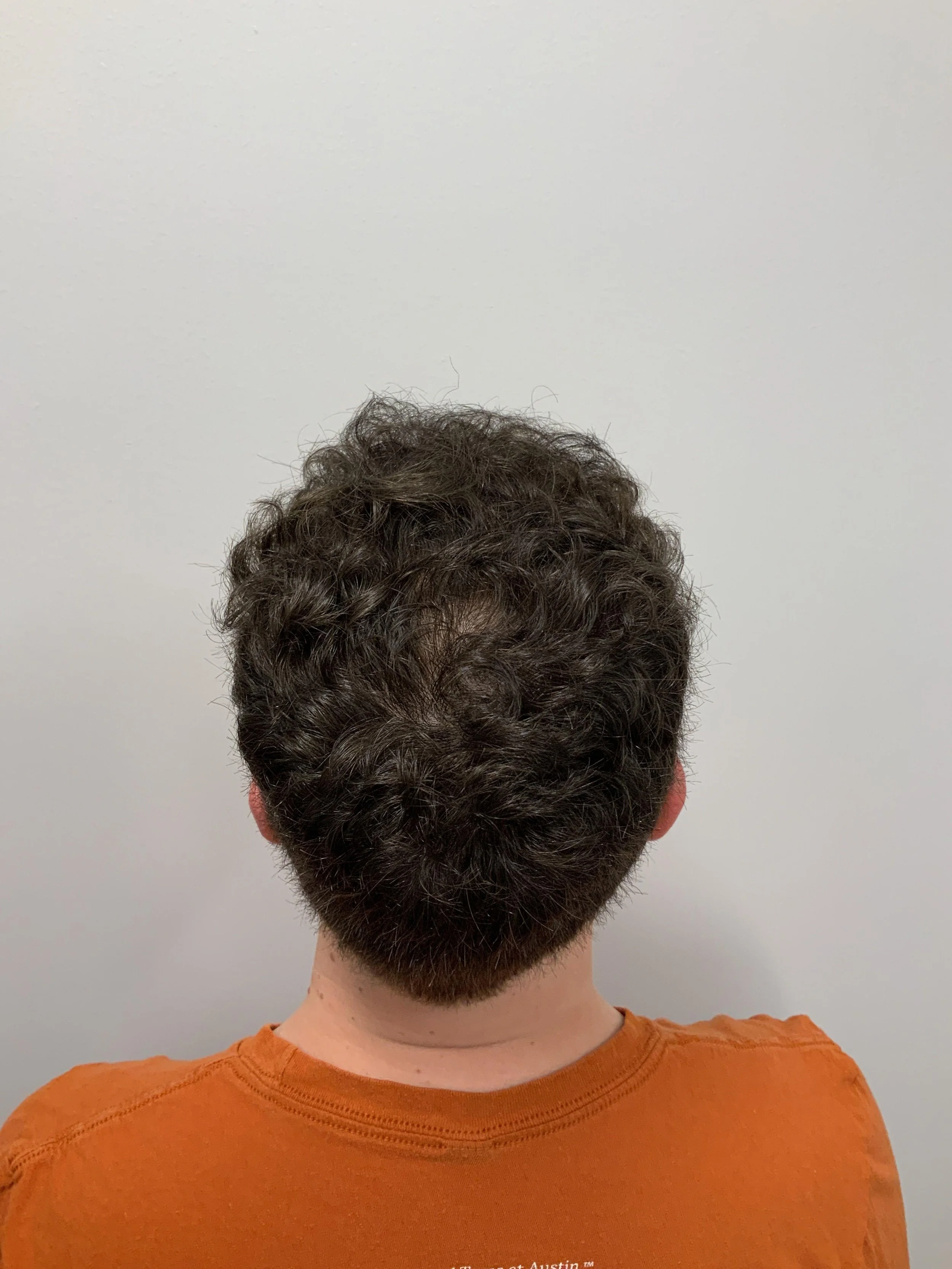 Crown view 1 year post op