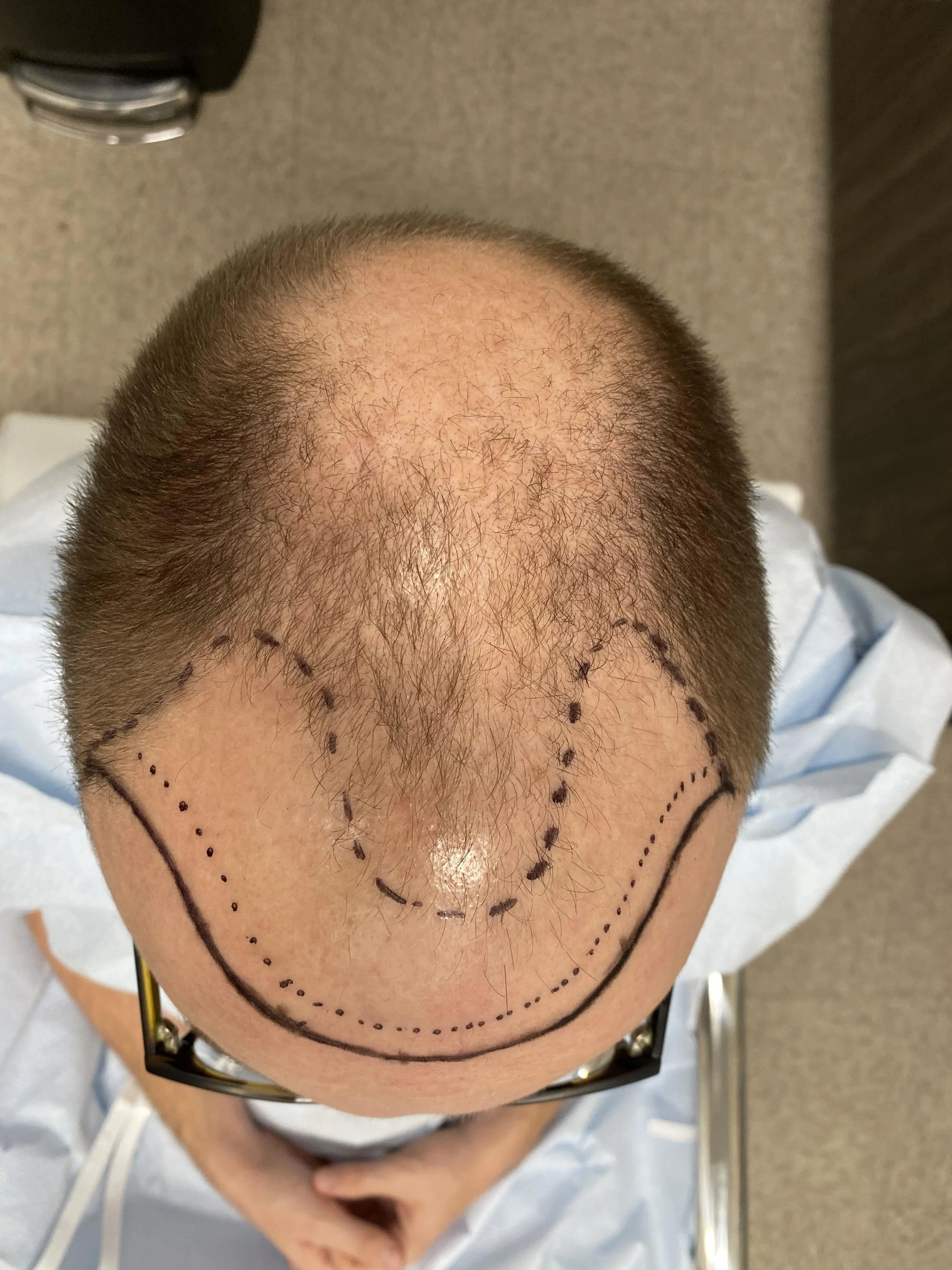 Top view pre-op plan for 2750 grafts to frontal scalp for first hair transplant