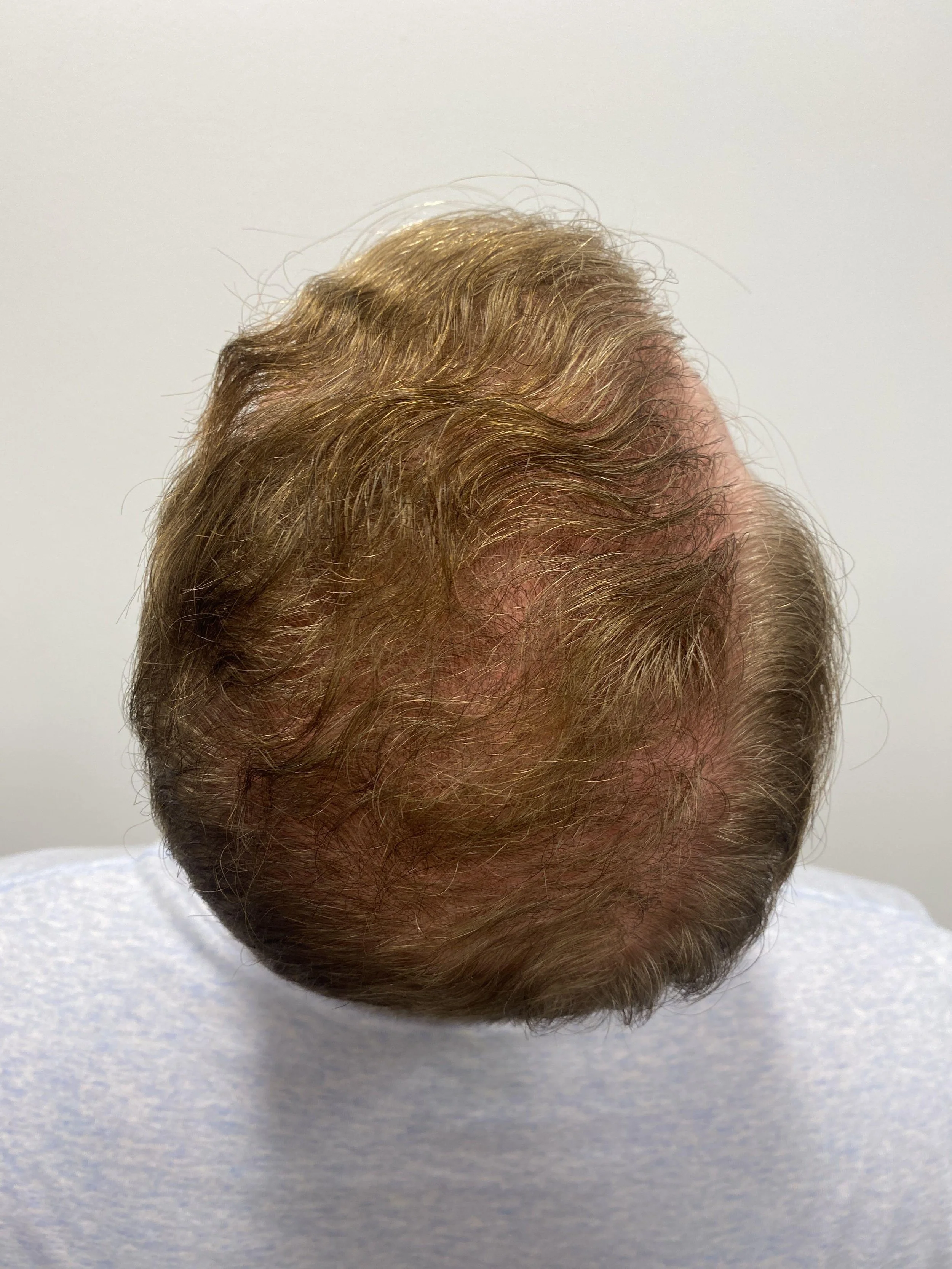 Crown View 1 Year Post Op with medical management 