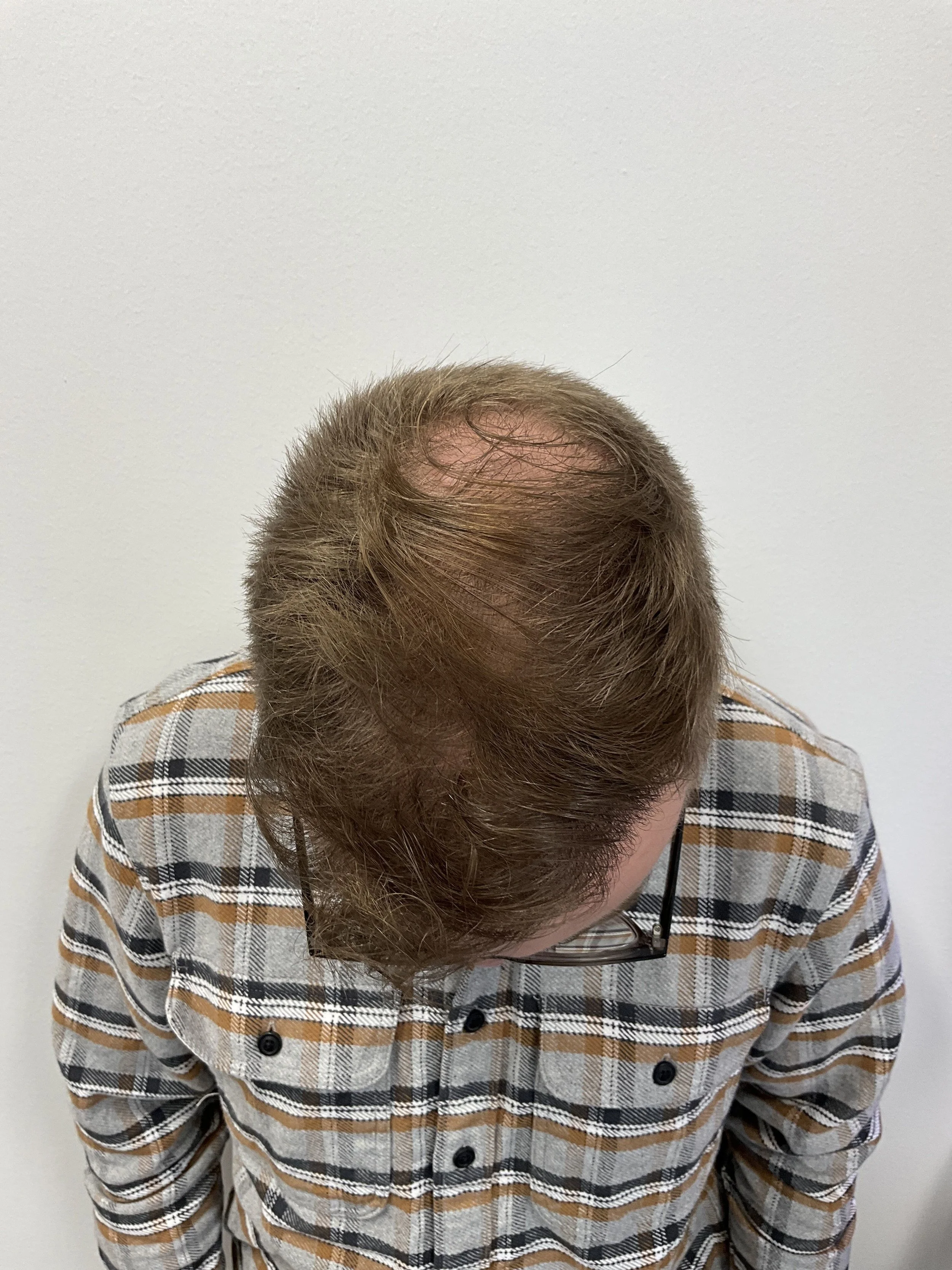 Top view 12 months after second hair transplant