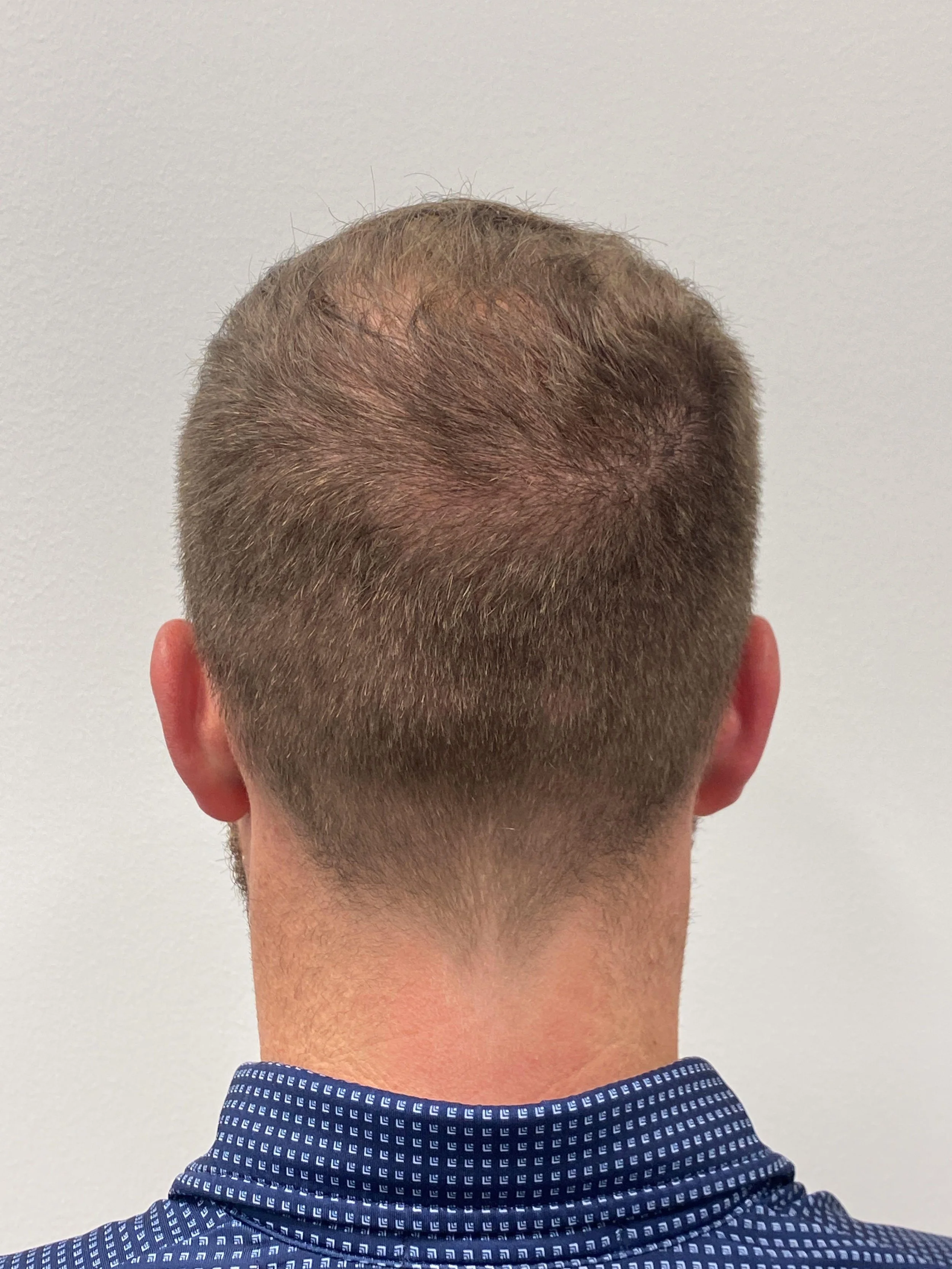 Donor area 10 months post op