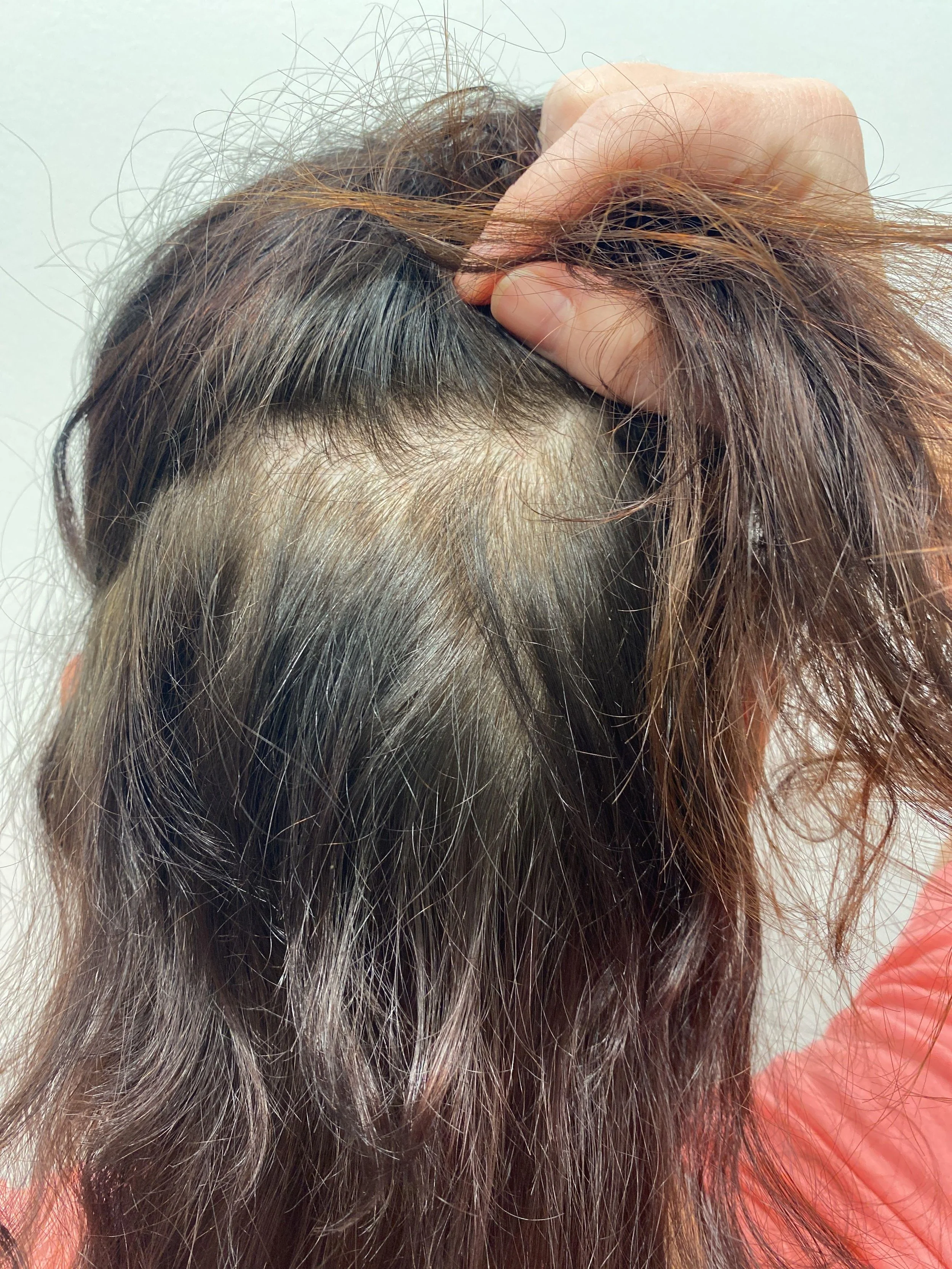 Donor area 7 months post op