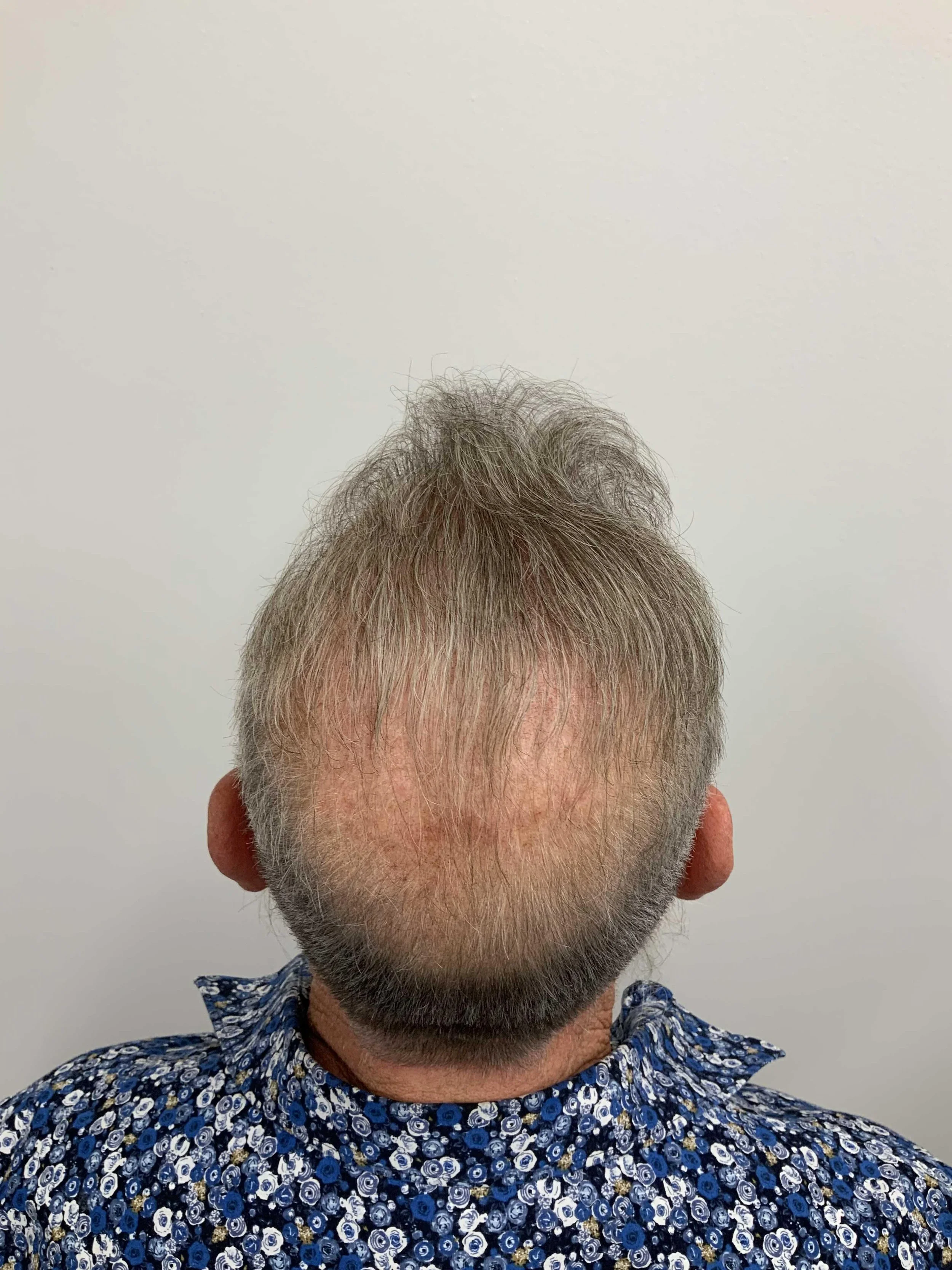 Crown view 9 months post op: No grafts were placed in the crown region