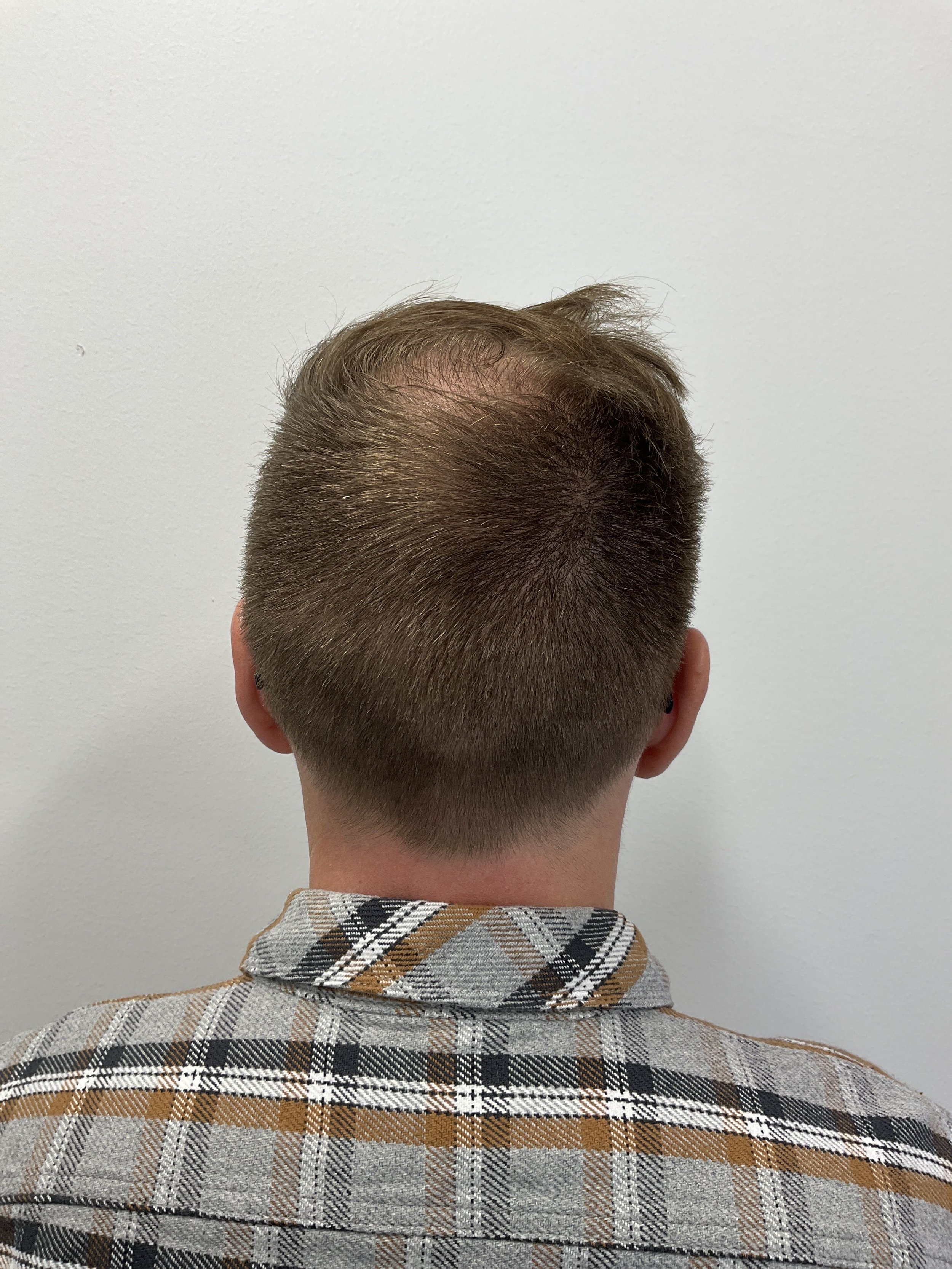 Donor area 12 months after second hair transplant