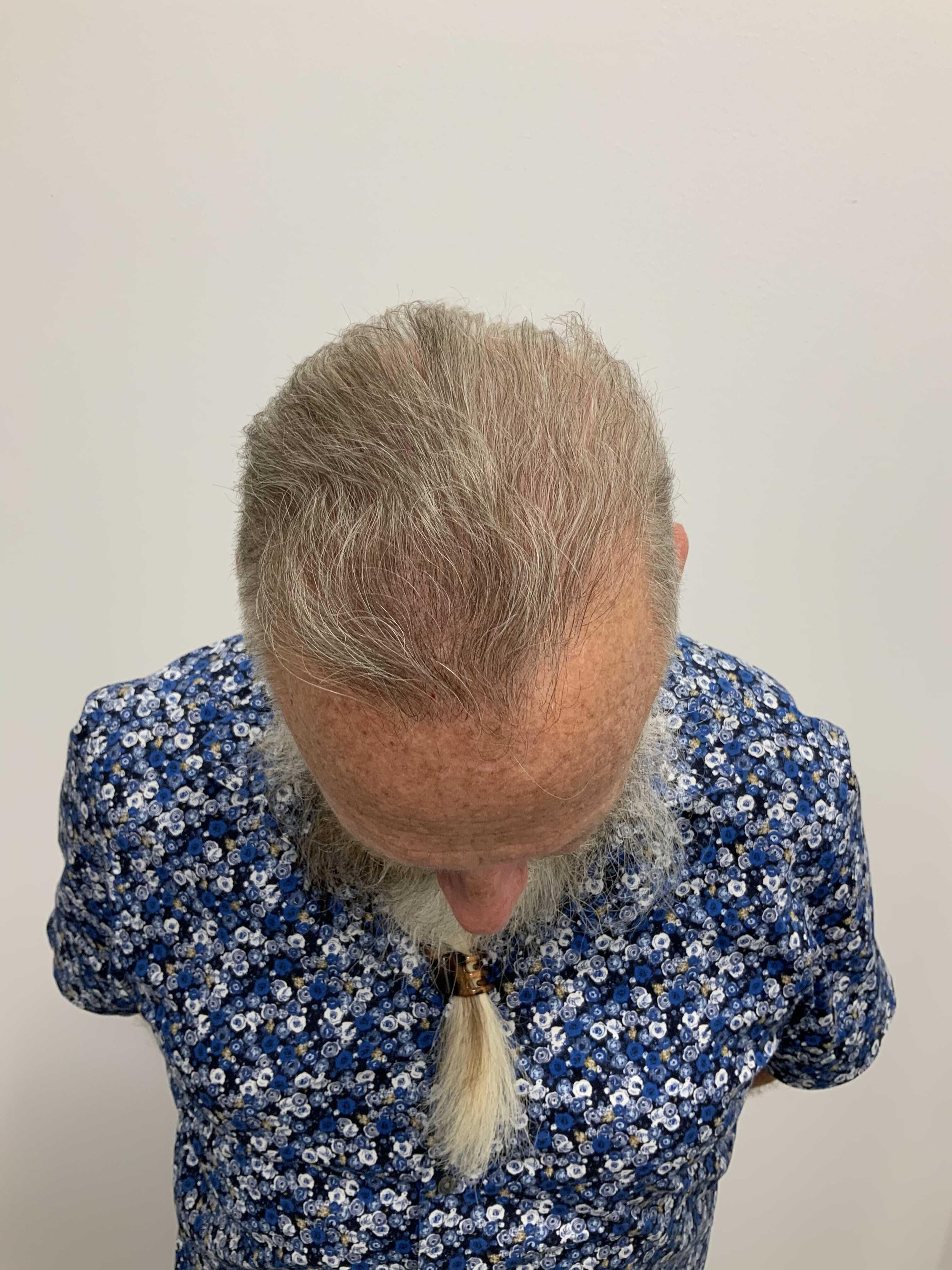 Top view 9 months post op