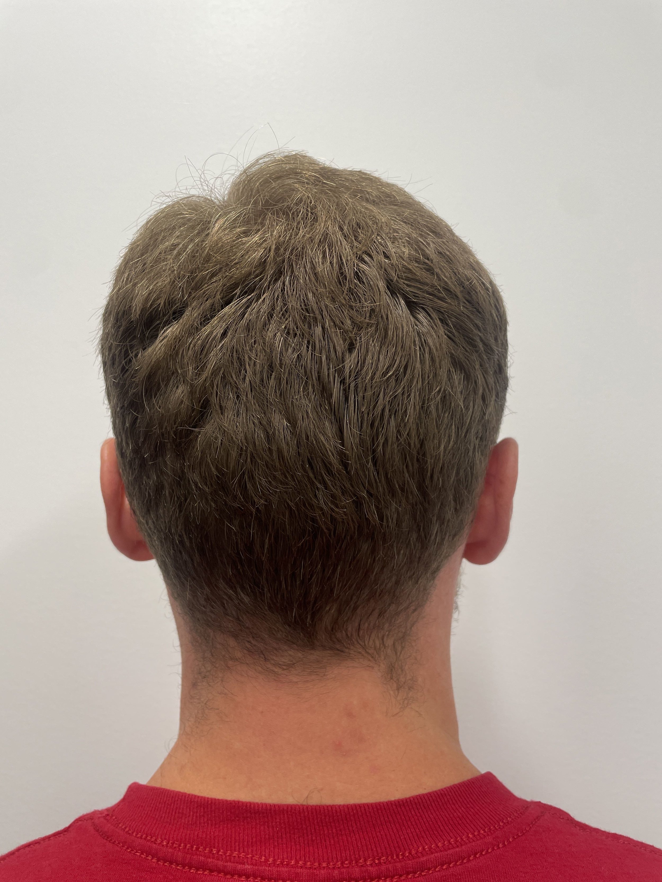 7 months post op donor area